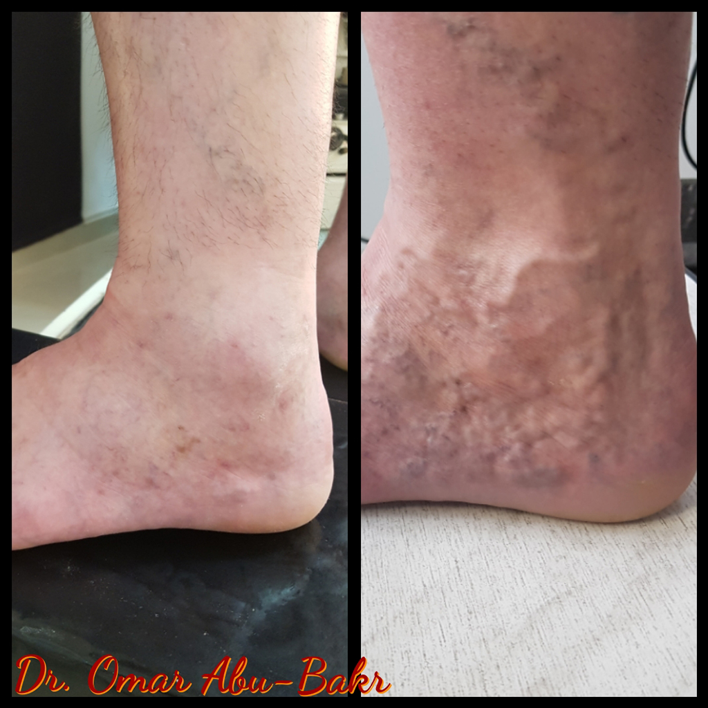 Varicose veins treatment for a patient of Dr Omar, The Veins Surgeon