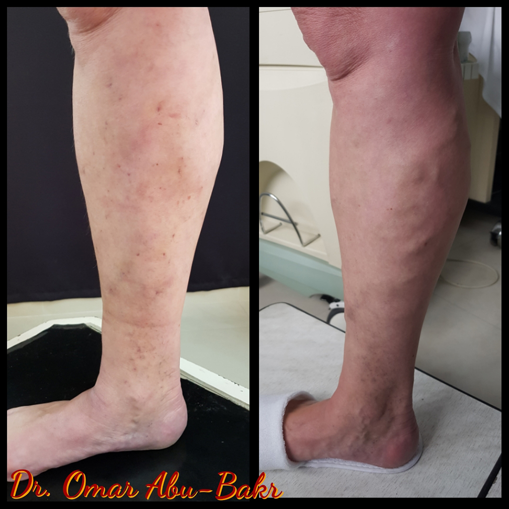Varicose Vein treatment images by The Veins Surgeon, Dr Omar