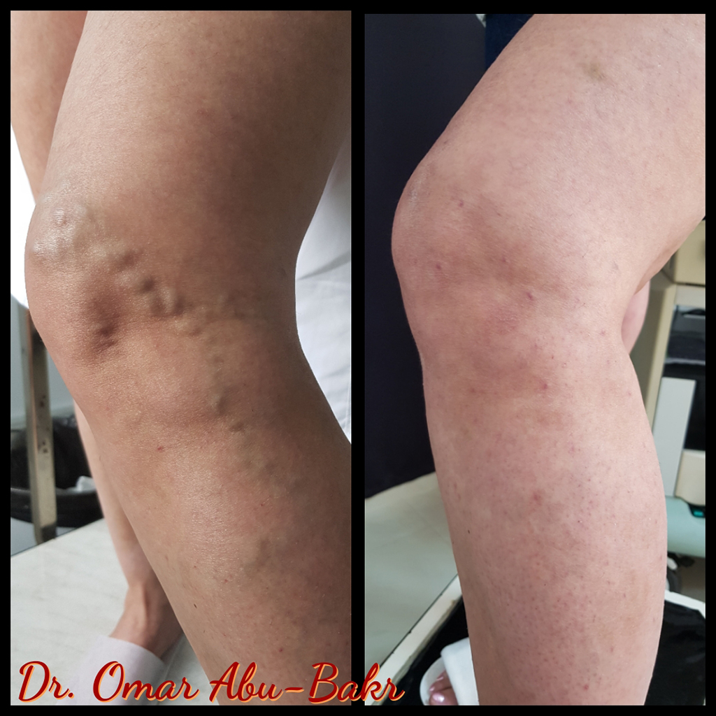 Varicose veins treatment for a patient of Dr Omar, The Veins Surgeon