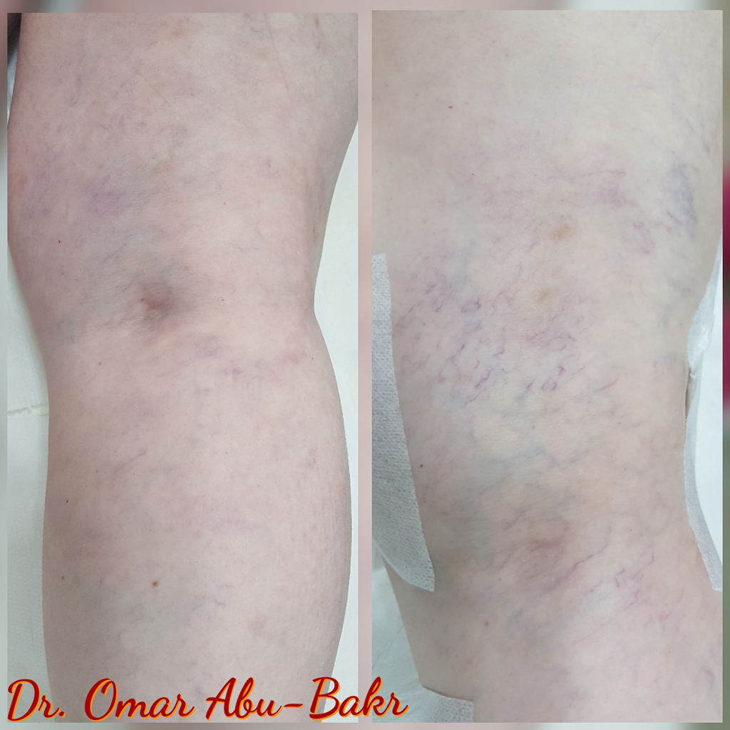 Spider veins treatment for a patient of Dr Omar, The Veins Surgeon