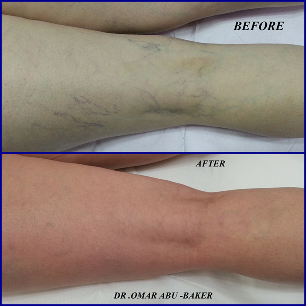 Spider veins treatment for a patient of Dr Omar, The Veins Surgeon
